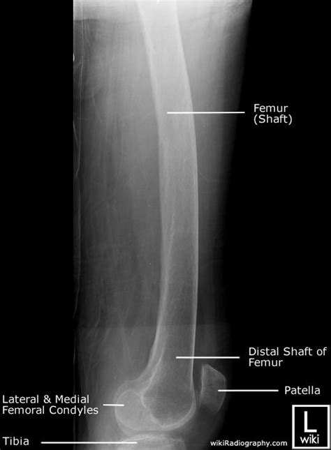 Radiographic Anatomy Femur Lateral Distal Medical Radiography