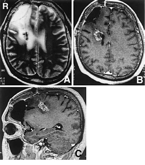 A Axial T Weighted Magnetic Resonance Mr Image Obtained Weeks