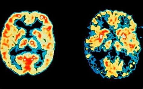 Brain Scanning Could Improve Dementia Diagnosis For Two Thirds Of