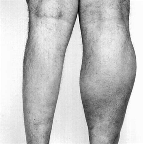 Désespoir Production Pion Muscle Atrophy Legs Cent Ans Rendre