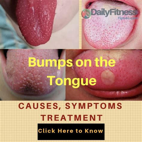 Bumps On Tongue Treatment Symptoms Causes Treatment And Prevention Of