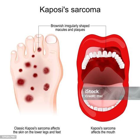 Kaposis Sarcoma Cancer Skin Lesions Stock Illustration Download Image