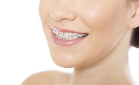 4 Teeth Straightening Options To Get Your Best Smile The Orthodontic