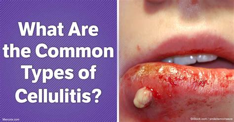 What Are The Common Types Of Cellulitis Infection