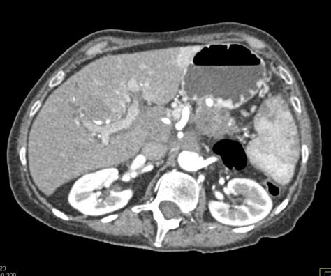 Pancreatic Adenocarcinoma With Liver Metastases And Left Femoral Vein