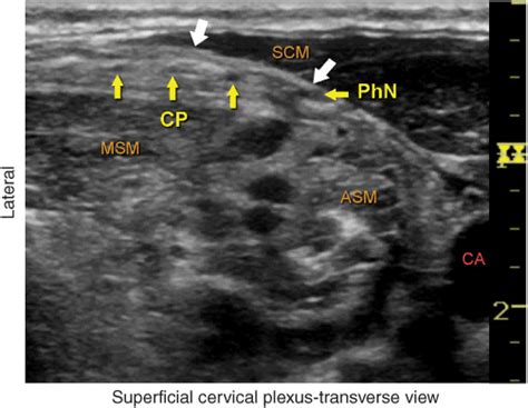 Ultrasound Guided Superficial Cervical Plexus Block Showing Spread Of