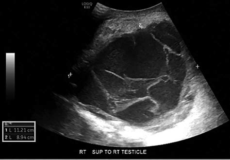 Scrotal Ultrasound Complex Septated Cystic Lesion On The Right Side Of