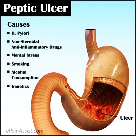 Peptic Ulcer Treatment Causes Symptoms Types Tests