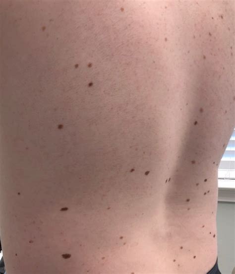 Atypical Nevus Pennsylvania Dermatology Specialists