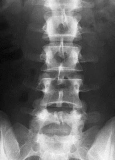 Radiology department of the rijnland hospital in leiderdorp fractures can cause stenosis of the spinal canal especially when there is displacement of bony structures like in burst fractures and fractures with. X-rays Spine