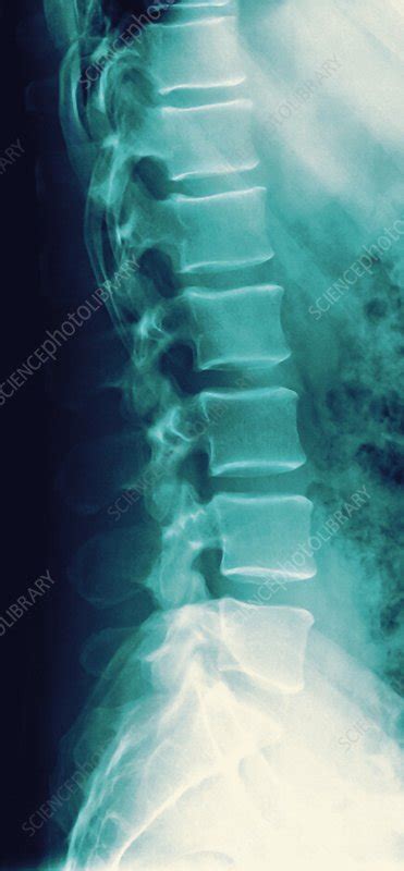 Normal Spine X Ray Stock Image F0012987 Science Photo Library