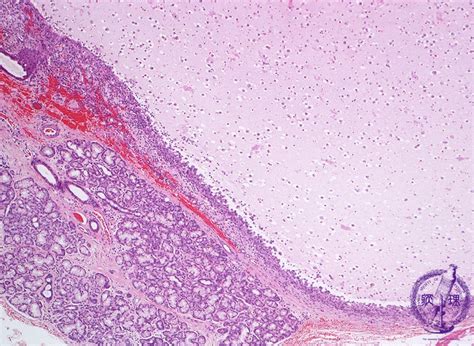 Oral Salivary Gland Mucocele Pathology Core Pictures