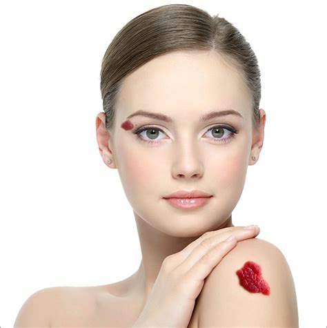 Red Birthmarks Laser Clinic Galway