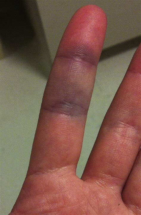 Acute Idiopathic Blue Finger Case Report Journal Of Hand Surgery