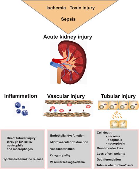 Acute Kidney Injury Diagram