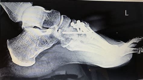 However, injury to the lisfranc joint is not a simple sprain that should be simply walked off. it is a severe injury that may take many months to heal and may require surgery to treat. Lisfranc injury fusion | Lisfranc injury, Injury