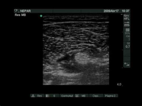 Surgery on the knee, calf, achilles tendon, foot, ankle. Ultrasound guided Infragluteal Sciatic Nerve Block.mov ...