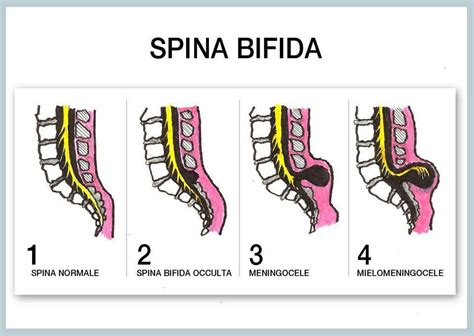 Pin By Regina Papp On Medicine And Surgery Pediatric Nursing Spina