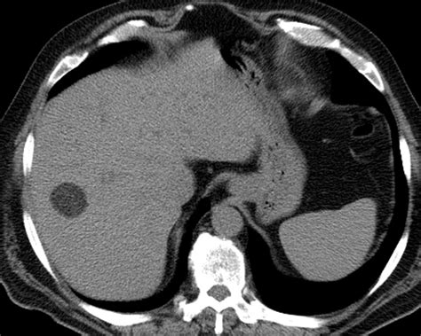 liver atlas case  extramedullary hematopoiesis mimicking lipoma
