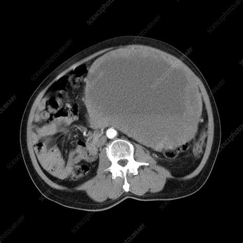 Abdominal Sarcoma Mri Scan Stock Image C0119571 Science Photo