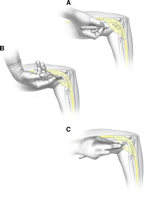 The Safety Of Using Proximal Anteromedial Portals In Elbow Arthroscopy