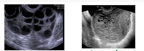 Genitourinary Radiology Horseshoe Kidney Micturatingvoiding