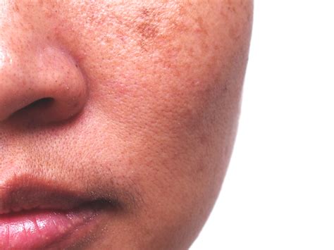 Age Spots How To Make Them Go Away Rao Dermatology