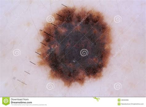 Nevus Stock Image Image Of Mole Medicine Skin Swelling 48452995