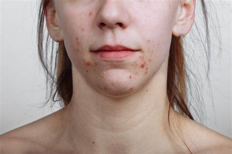 Acne Can Take Big Emotional Toll On Women Plastic Surgery Practice