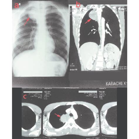 A Displays Chest X Ray Showing Soft Tissue Density In Right Thoracic