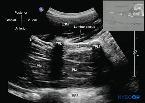 Ultrasound Imaging Of The Lumbar Spine For Central Neuraxial Blocks Images