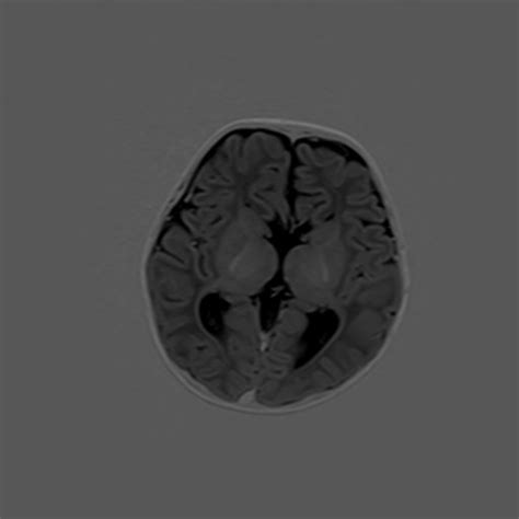 Agenesis Of The Corpus Callosum Image Radiopaedia Org