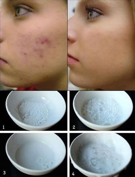 This extract is widely available in scar treatment products that are available at drug. DIY Pimple Scar Remover | Spa Tips & Treatments | Pinterest
