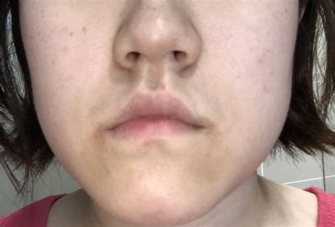Skin Concerns Severe Discoloration Around Mouth Rskincareaddiction
