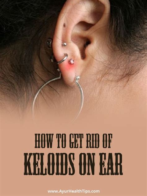 How To Get Rid Of Keloids 9 Home Remedies And Treatments Ayur Health Tips Ear Piercing Care