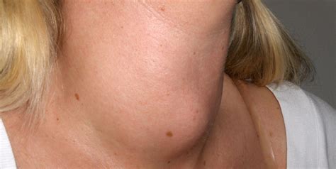 General Hyperthyroidism Thyroid Center Of Santa Monica