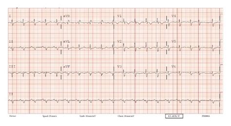 Vanaf het hart vertakt de longslagader zich in een embolie is de afsluiting van een bloedvat door een bloedstolsel (trombus). Electrocardiogram at presentation showing sinus ...
