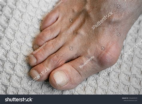 Swelling Joints Toes Painful Gout Inflammation Stock Photo 1954403533