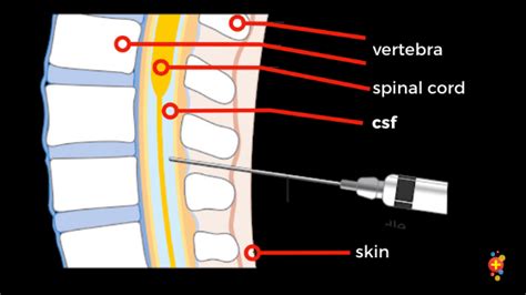 Lumbar Puncture Anatomy Layers