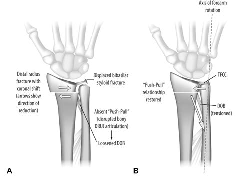 Coronal Shift Of Distal Radius Fractures Influence Of The Distal Interosseous Membrane On