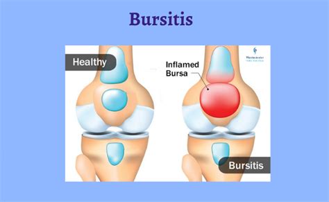 Bursitis Causes Diagnosis And Treatment Dubai Healthcare City