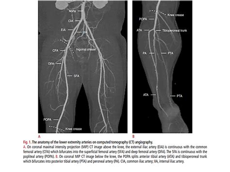 Bilateral Arterial Lower Extremity