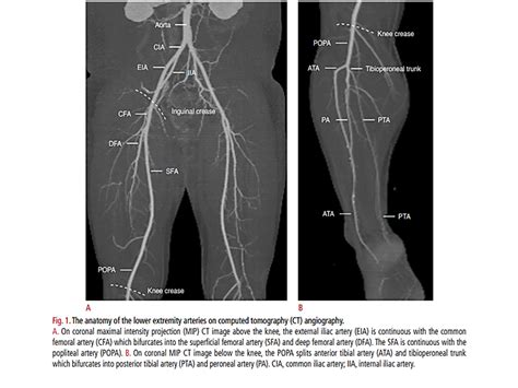 BÀi SoẠn VỀ SiÊu Âm ChẨn ĐoÁn Doppler Ultrasonography Of The Lower