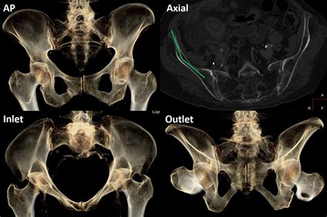 Ap Inlet Outlet X Ray And Axial Ct Cuts Of A Female Pelvis The Axial