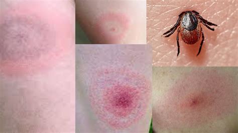 Tick Bites How They Look Like Tick Borne Diseases Symptoms Preventions