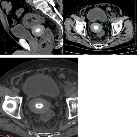 Pet Ct Of Abdomen Shows Similar Well Defined Round To Oval Mass In The