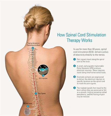 Chronic Pain | Boston Scientific