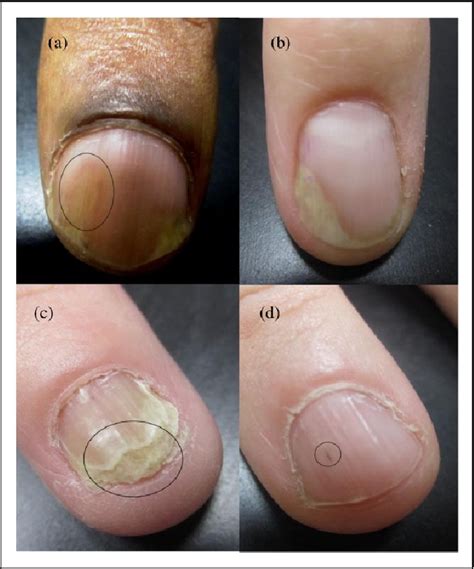 Figure 1 From Psoriatic Nail Changes Are Associated With Clinical