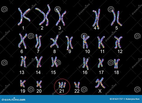 Karyotype De Síndrome De Down Ilustração Stock Ilustração de gene
