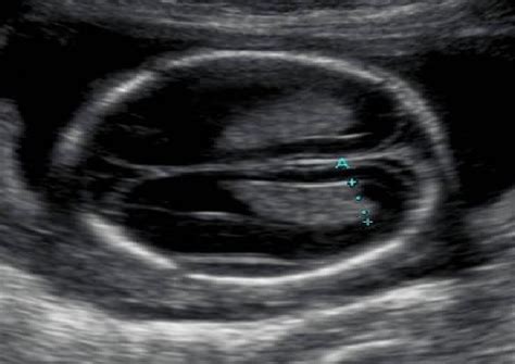 Sonographic Assessment Of Normal Fetal Cerebral Lateral Ventricular